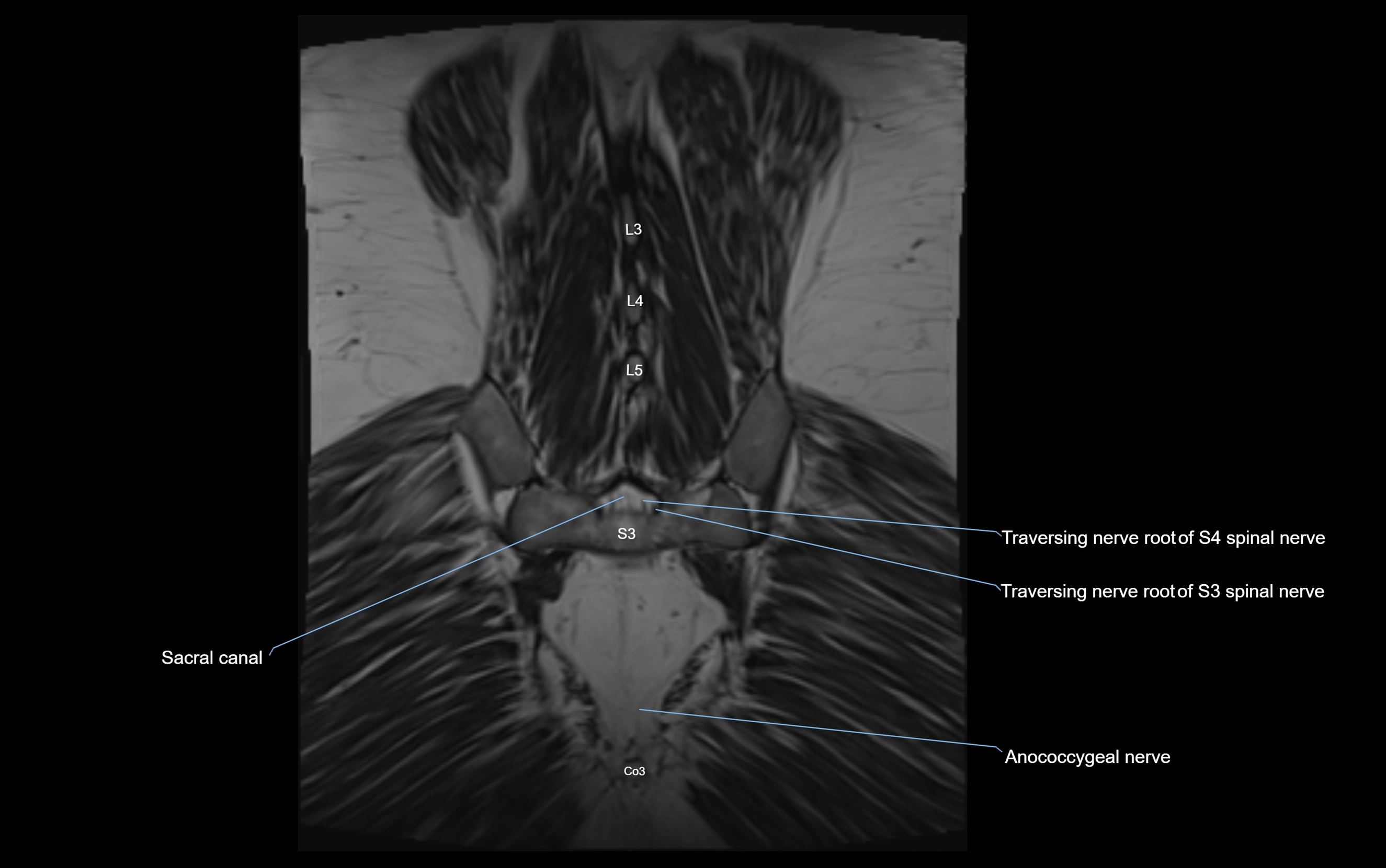 MR lumbosacral plexus cross sectional anatomy 3T  radiology  image-img-09001-00072.webp
